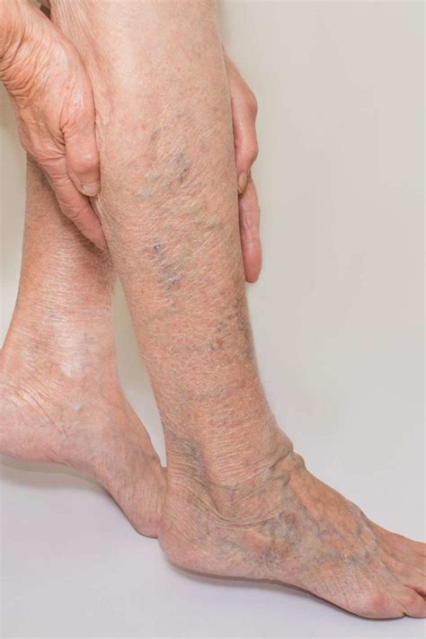 Palha Frente No Geral Best Cream For Veins On Legs Secretário Castanho