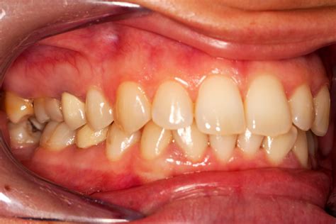 Early Warning Signs Of Gum Disease Hinsdale Dentistry