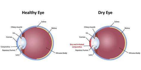 Dry Eyes Invision Optometry