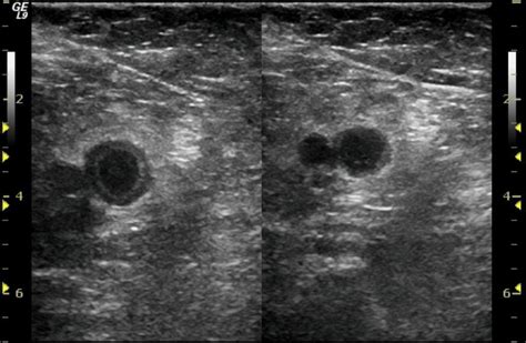 Deep Vein Thrombosis And Thrombocytosis Evaluation And Management