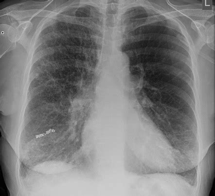 Pulmonary Embolization Coils Radiology Case Radiopaedia Org