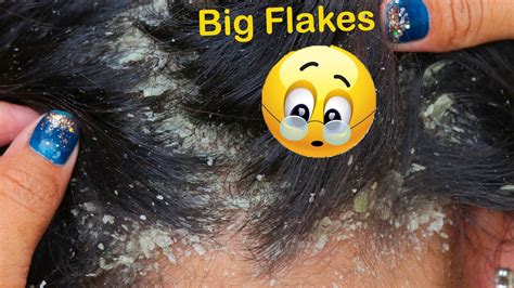 Itching Huge Flake Dandruff Scratching Scalp Psoriasis Youtube