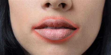 Heat Rash On Lips Treatment