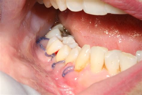 Localized Gingival Erythroleukoplakia In A 57 Year Old Fanconi Anemia
