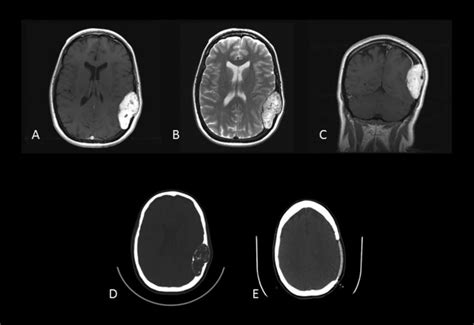 Case 2 Preoperative Axial Postcontrast T1 Weighted Mri A Axial
