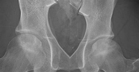 Roentgen Ray Reader Ficat Classification Of Avascular Necrosis Avn