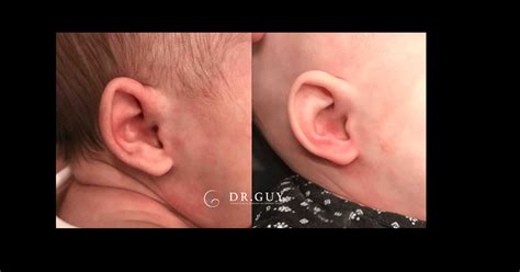 Ear Rejuvenation Surgery Infant Ear Correction Waco Tx