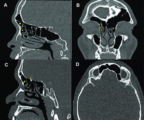 Computed Tomography Ct Of Paranasal Sinuses Showing Identification Of