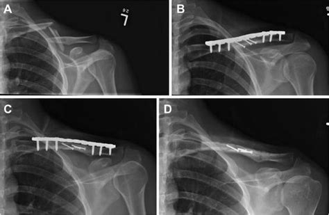 Midshaft Clavicle Injuries Operative Management Musculoskeletal Key