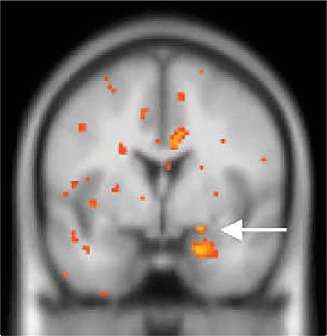 The Fmri Displays Activation Of Fearful Vs Happy Facial Expressions In