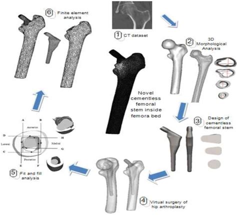 Summarize Steps Of Designing The Cementless Hip Arthroplasty