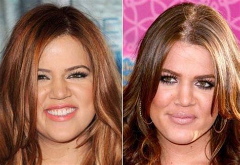Khloe Kardashian Before And After Plastic Surgery 09 Celebrity