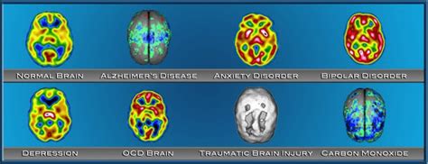 In Need Of Finding Brain Scans Of Mood And Personality Disorders Where