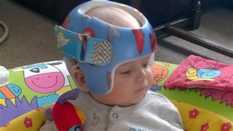 Baby Whose Head Is As Wide As It Is Long Fitted With Helmet To Make