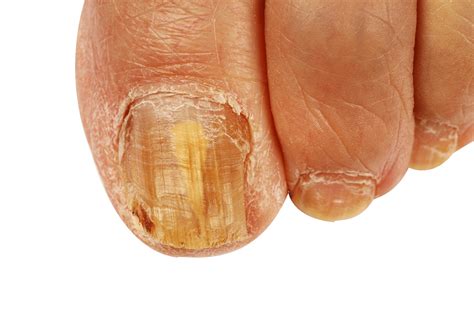 You've picked up a fungus , which you can get if you walk barefoot in common areas like a gym shower or locker room. Nail Fungal Infection Treatment with Loceryl 5% Nail Lacquer
