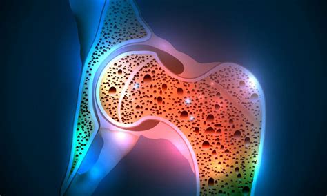 Osteoporosis Symptoms Causes And Other Risk Factors