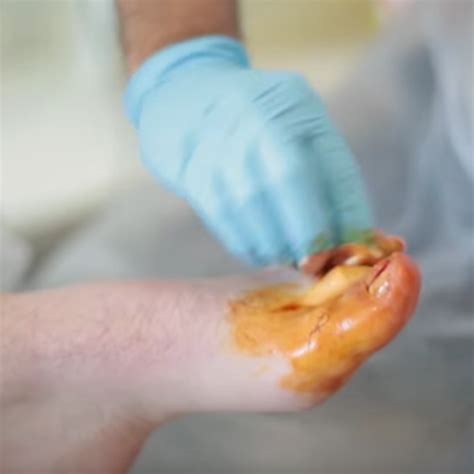 An ingrown toenail is a common problem where the nail grows into the toe. Ingrown Toenail Removal Cost Uk - Nail Ftempo