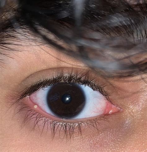 painful bump on eye, what could it be? : r/eyetriage