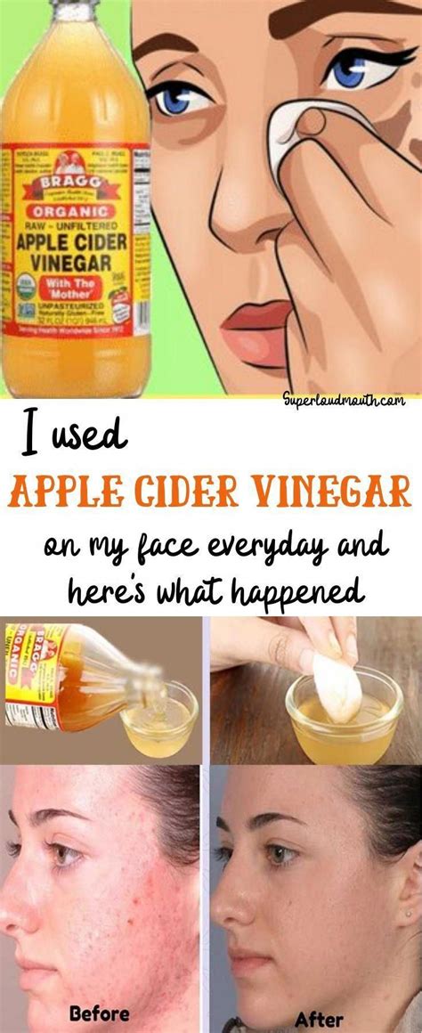How To Use Apple Cider Vinegar On Skin For Acne Spots And Other Skin