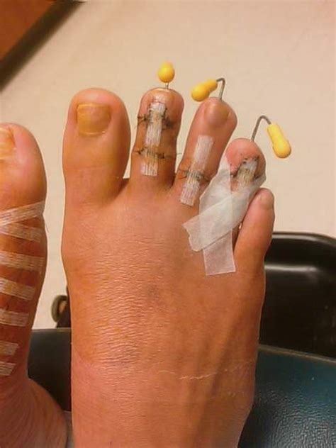 My Toe Shortening Surgery Foot Surgery Surgery Bunion