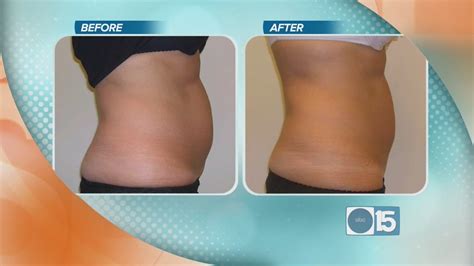 North Valley Plastic Surgery Center Offers Nonsurgical Body Contouring With V Shape Youtube