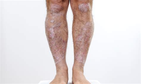 9 Best Ways To Speed Healing Of Psoriasis On Legs Nuvothera