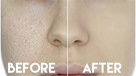 How To Hide Enlarged Pores And Make Your Pores Disappear Youtube