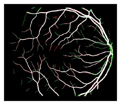 Segmented Blood Vessels With Stare And Their Comparison With Manually