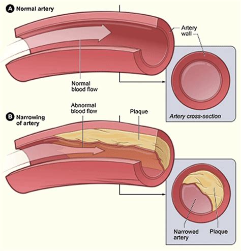 Atherosclerosis Causes Risk Factors Symptoms Diagnosis And Treatment