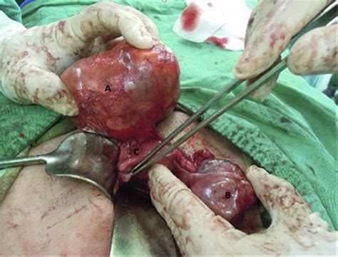 A An Extragonadal Mature Cystic Teratoma And B A Right Ovarian