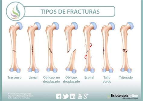 Fracturas óseas Tipos Cuidados Y Tratamiento Fisioonline