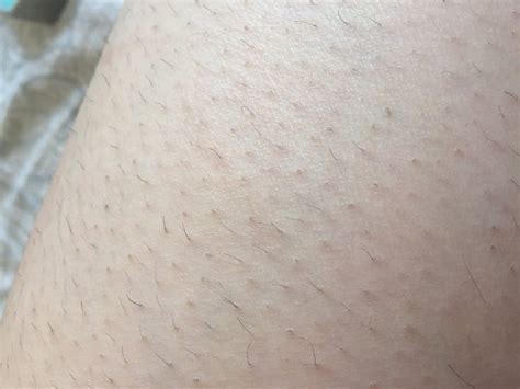 Skin Concern My Legs Are Covered In Ingrown Hairs Is There A Way To