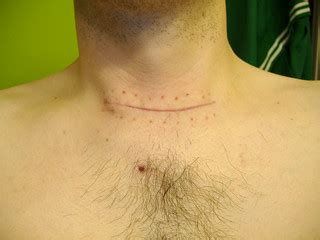 Thyroid Scar Day 9 Paul Kenjerski Flickr