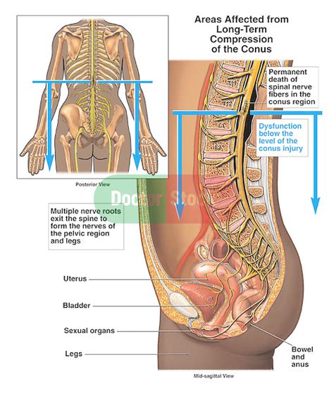 Endometriosis can cause pain in the lower back or pelvis. Long-term Effects of Lower Spinal Cord Compression ...