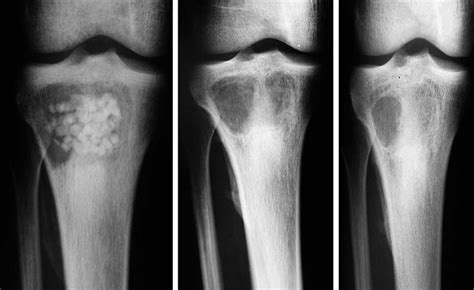 Ap Views Of Right Tibia 1 3 And 6 Months After Debridement And