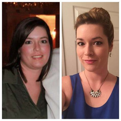 Hypothyroid In Photos Before And After With Images Thyroid