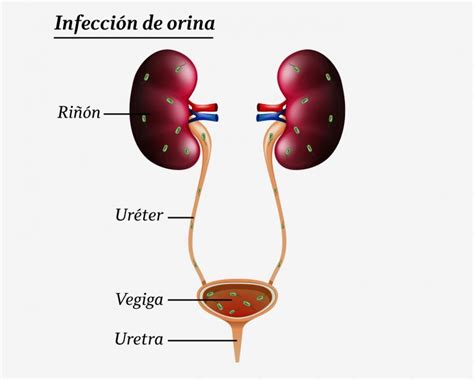 Infección Urinaria Dra Teresa Aznar