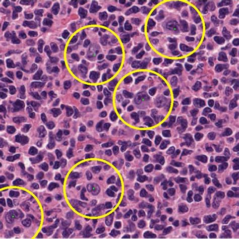 An Example Of Part Of An Hande Stained Follicular Lymphoma Image With