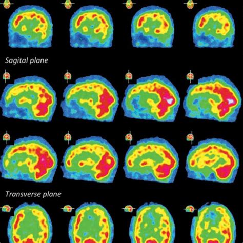 Brain Scintigraphy Single Photon Emission Computed Tomography Of Asp