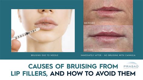How To Minimize Bruising After Lip Injections Infoupdate Org