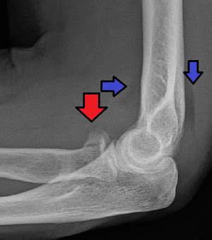 Radial head fracture - Wikipedia