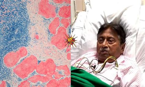 Here Is All You Need To Know About Amyloidosis A Disease That Has Worsened The Health Of