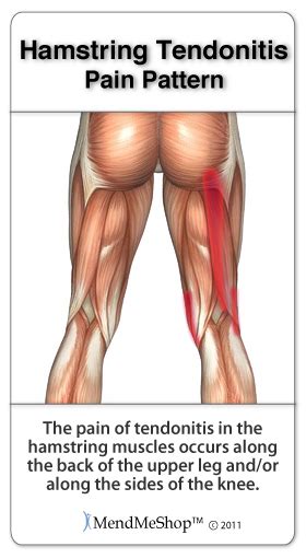 Hamstring Tendinitis Symptoms And Treatment