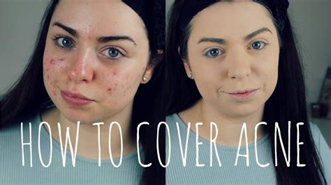How To Cover Acne Acne Coverage Foundation Routine Youtube