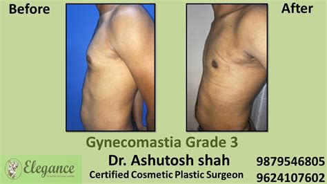 male breast reduction surgery valsad gujarat