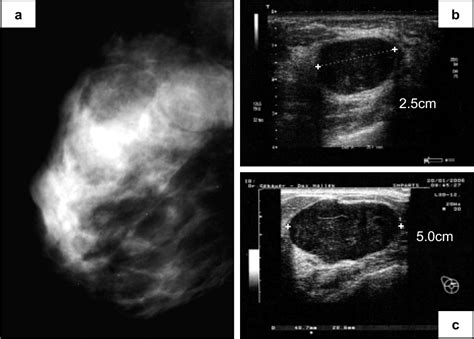 Figure 1 From A Case Of Phyllodes Tumor With Focal Transition Into Low