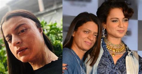 kangana s sister rangoli on horrifying acid attack 54 surgeries and 5 years of treatment