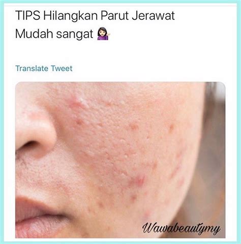 Ini cara menghilangkan bekas jerawat secara alami & cepat. TIPS KECUTKAN JERAWAT . TONER TIMUN Toner timun mampu ...