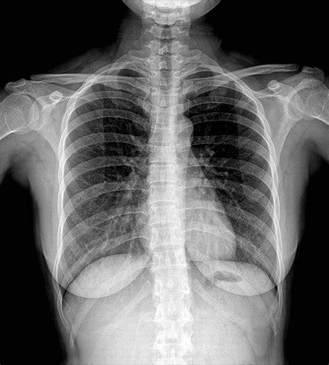 Sprains/Soft Tissue Injuries-Acute Stage 1