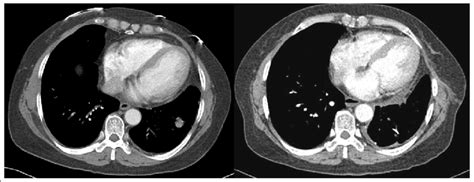 On Chest CT Scan Cm Sized Solitary Pulmonary Nodule Was Noted In Download Scientific